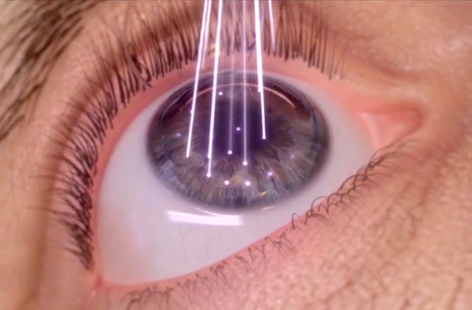 LASIK Surgery | Eye Clinic & Laser Centre | Navi Mumbai