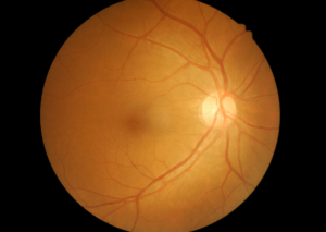 diabetic retinopathy | Eye Clinic & Laser Centre | Navi Mumbai